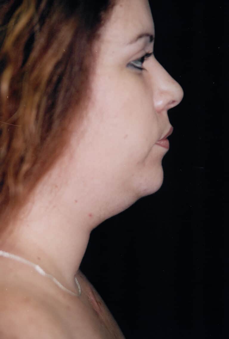 Before Image: Neck Liposuction - right-side